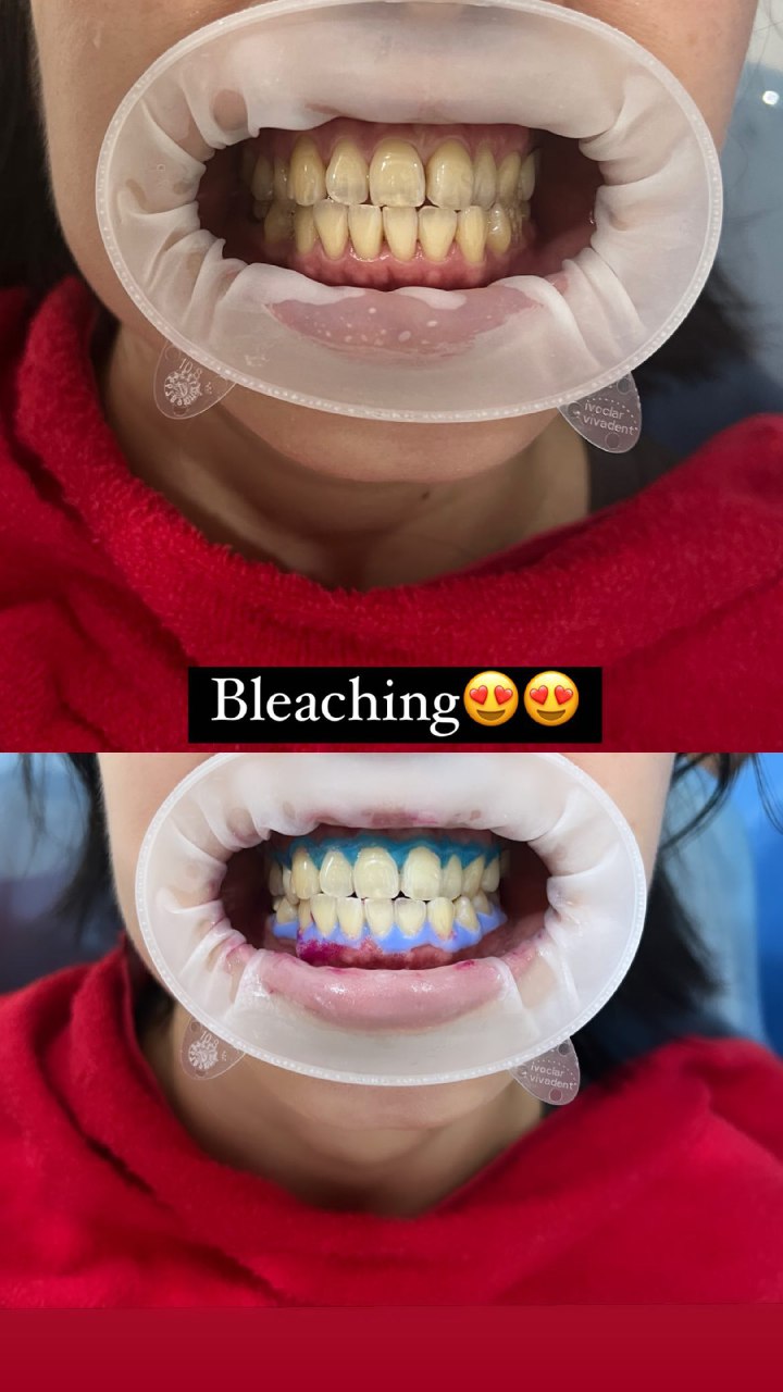Bleaching 12