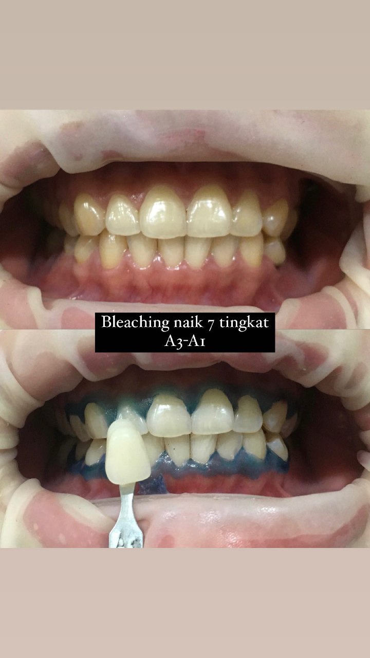Bleaching 7