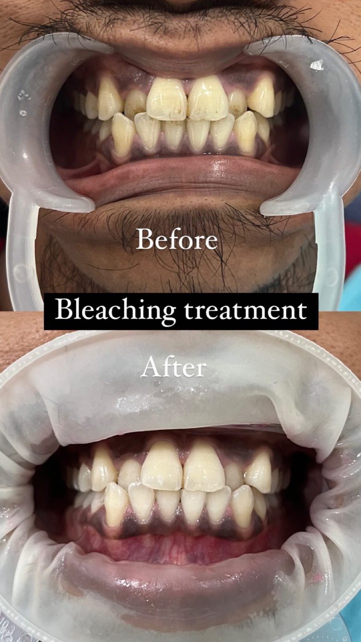 Bleaching 9