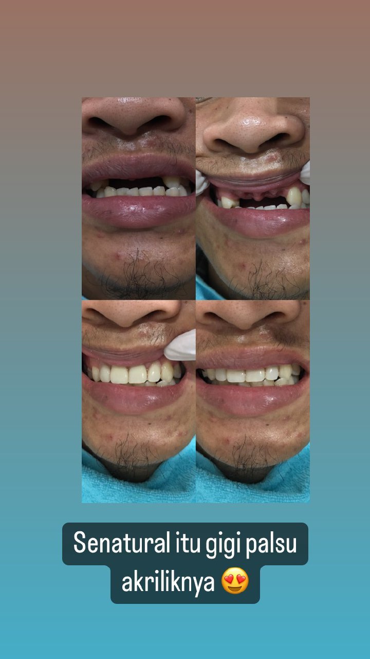 Gigi Palsu 14