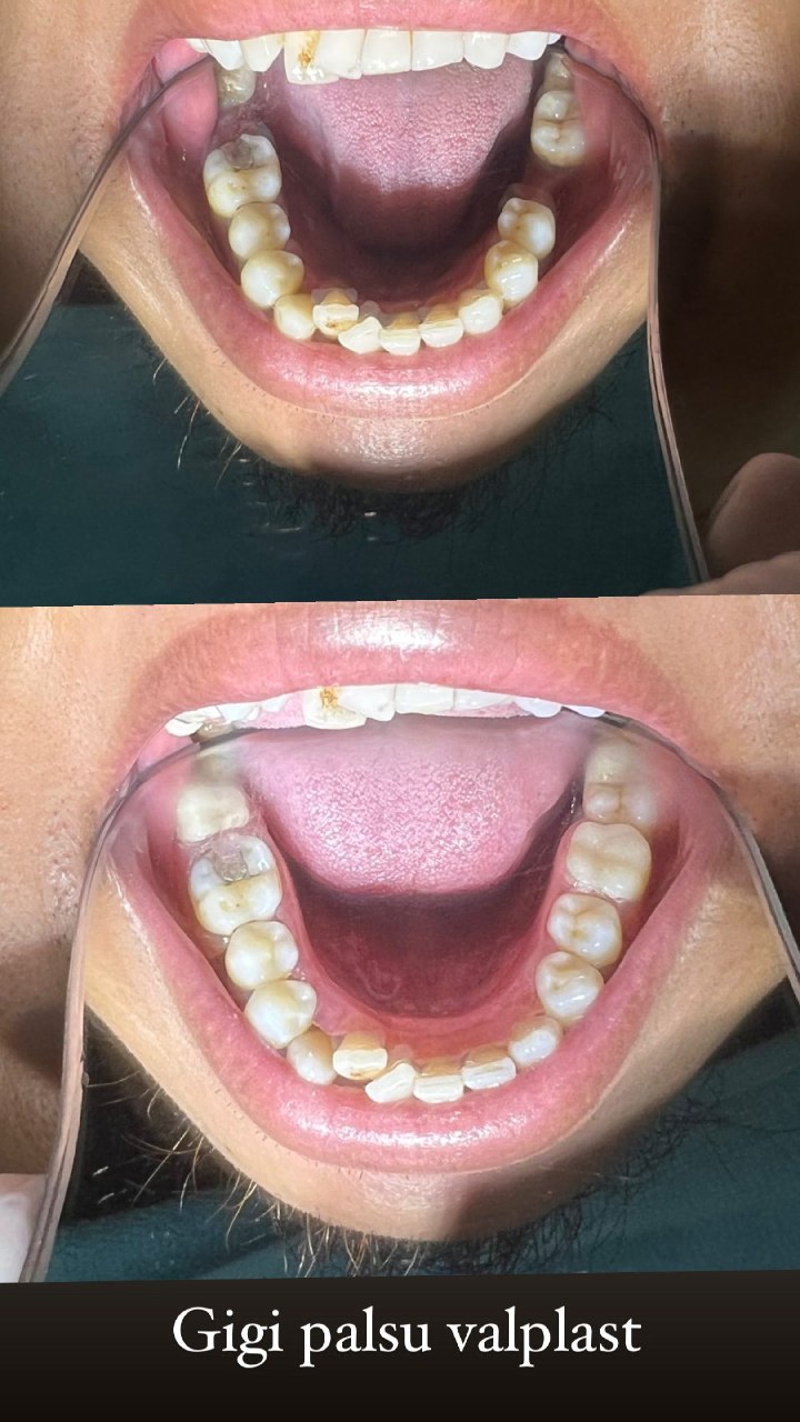 Gigi Palsu 16