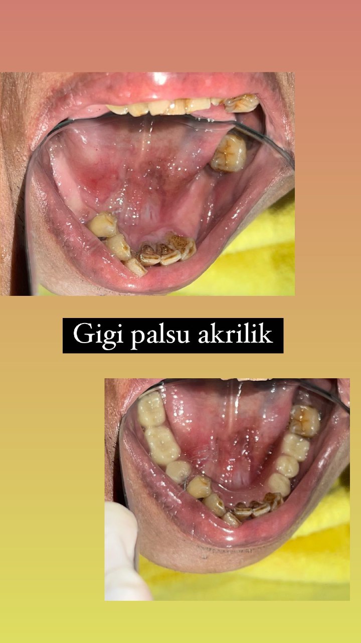 Gigi Palsu 2
