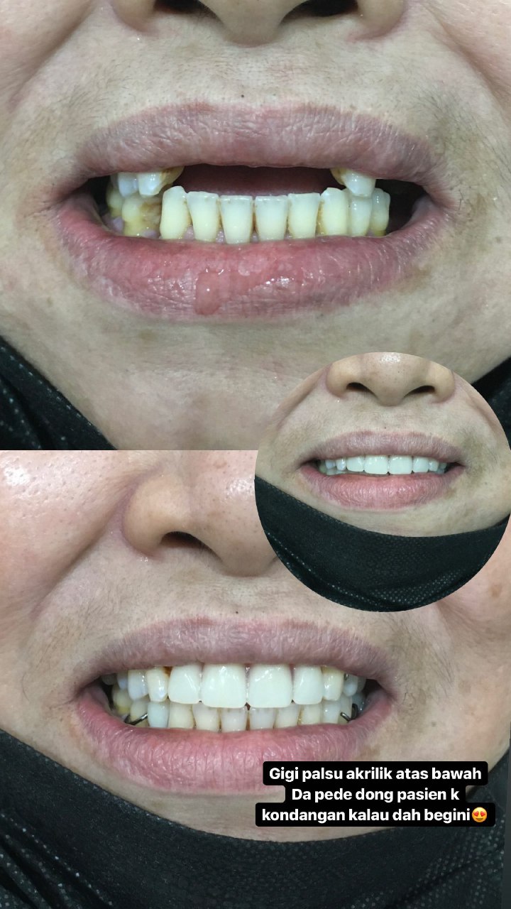 Gigi Palsu 21