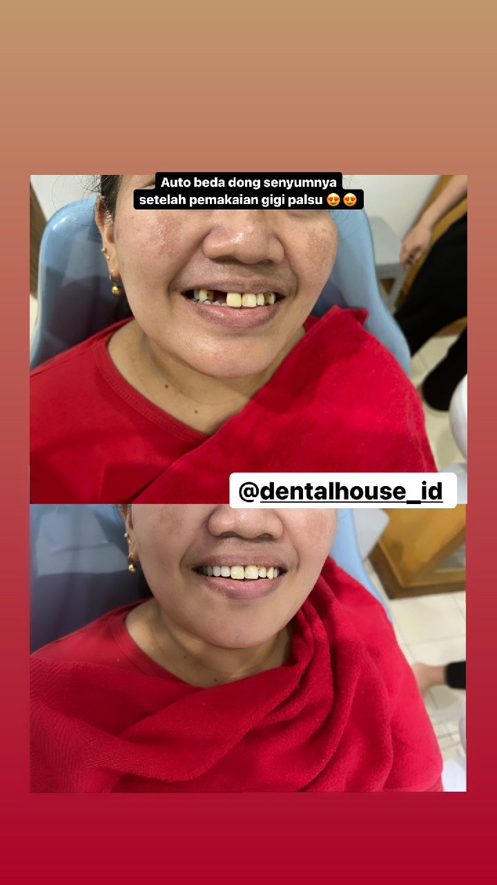 Gigi Palsu 27