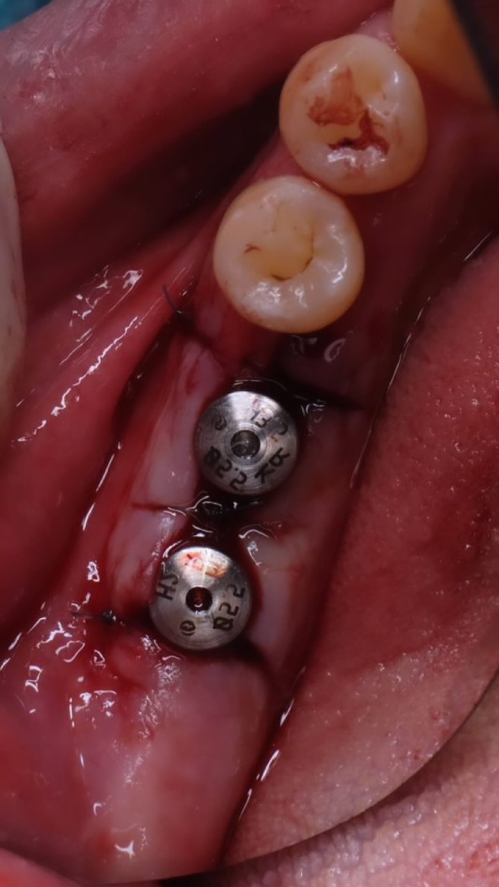 Implant 1